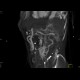 Obliteration of the coeliac trunk and superior mesenteric artery, massive collateral flow: CT - Computed tomography