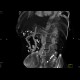 Obliteration of the coeliac trunk and superior mesenteric artery, massive collateral flow: CT - Computed tomography