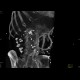 Obliteration of the coeliac trunk and superior mesenteric artery, massive collateral flow: CT - Computed tomography