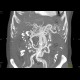 Obliteration of the coeliac trunk and superior mesenteric artery, massive collateral flow: CT - Computed tomography