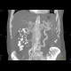 Obliteration of the coeliac trunk and superior mesenteric artery, massive collateral flow: CT - Computed tomography