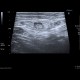 Reactive lymph nodes in interferon treatment: US - Ultrasound