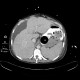 Variceal bleeding, Segstaken tube, liver cirrhosis, portal hypertension, varices, ascites, rectal tube: CT - Computed tomography