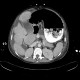 Variceal bleeding, Segstaken tube, liver cirrhosis, portal hypertension, varices, ascites, rectal tube: CT - Computed tomography