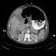 Variceal bleeding, Segstaken tube, liver cirrhosis, portal hypertension, varices, ascites, rectal tube: CT - Computed tomography