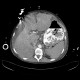 Variceal bleeding, Segstaken tube, liver cirrhosis, portal hypertension, varices, ascites, rectal tube: CT - Computed tomography