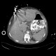 Variceal bleeding, Segstaken tube, liver cirrhosis, portal hypertension, varices, ascites, rectal tube: CT - Computed tomography