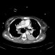 Variceal bleeding, Segstaken tube, liver cirrhosis, portal hypertension, varices, ascites, rectal tube: CT - Computed tomography