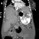 Variceal bleeding, Segstaken tube, liver cirrhosis, portal hypertension, varices, ascites, rectal tube: CT - Computed tomography