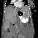 Variceal bleeding, Segstaken tube, liver cirrhosis, portal hypertension, varices, ascites, rectal tube: CT - Computed tomography