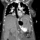 Variceal bleeding, Segstaken tube, liver cirrhosis, portal hypertension, varices, ascites, rectal tube: CT - Computed tomography