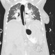 Variceal bleeding, Segstaken tube, liver cirrhosis, portal hypertension, varices, ascites, rectal tube: CT - Computed tomography