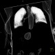 Variceal bleeding, Segstaken tube, liver cirrhosis, portal hypertension, varices, ascites, rectal tube: CT - Computed tomography