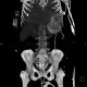 Variceal bleeding, Segstaken tube, liver cirrhosis, portal hypertension, varices, ascites, rectal tube: CT - Computed tomography