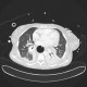 Variceal bleeding, Segstaken tube, liver cirrhosis, portal hypertension, varices, ascites, rectal tube: CT - Computed tomography