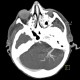 Venous angioma, cerebellum: CT - Computed tomography