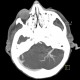 Venous angioma, cerebellum: CT - Computed tomography