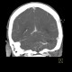 Venous angioma, cerebellum: CT - Computed tomography