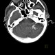 Venous angioma, cerebellum: CT - Computed tomography