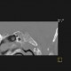 Axis, C2, development of vertebra: CT - Computed tomography