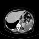 Splenic infarction, development in time: CT - Computed tomography