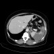 Splenic infarction, development in time: CT - Computed tomography