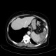 Splenic infarction, development in time: CT - Computed tomography