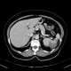 Splenic infarction, development in time: CT - Computed tomography