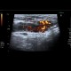 Varices in groin, inguinal canal: US - Ultrasound
