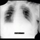 Chondroma of humerus, enchondroma: X-ray - Plain radiograph