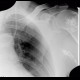 Chondroma of humerus, enchondroma: X-ray - Plain radiograph