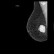 Breast carcinoma, big: MMG - Mammography