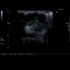 Breast carcinoma, big, tumour: US - Ultrasound