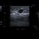 Breast carcinoma, big, lymph node: US - Ultrasound