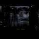 Breast carcinoma, big, tumour: US - Ultrasound