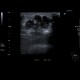 Breast carcinoma, big, tumour: US - Ultrasound