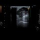 Breast carcinoma, big, tumour: US - Ultrasound
