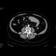 Venous infarzation of a jejunal loop: CT - Computed tomography