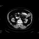 Venous infarzation of a jejunal loop: CT - Computed tomography