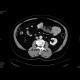 Venous infarzation of a jejunal loop: CT - Computed tomography