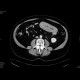 Venous infarzation of a jejunal loop: CT - Computed tomography