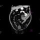 Venous infarzation of a jejunal loop: CT - Computed tomography