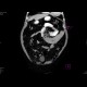 Venous infarzation of a jejunal loop: CT - Computed tomography