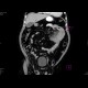 Venous infarzation of a jejunal loop: CT - Computed tomography