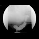 Ventral rectocoele, defecography: RF - Fluoroscopy