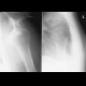 Ventrocaudal dislocation of shoulder: X-ray - Plain radiograph