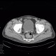 Vesicoureteral reflux: CT - Computed tomography