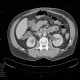 Vesicoureteral reflux: CT - Computed tomography