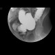 Inner hemorrhoids, irrigography: RF - Fluoroscopy