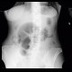 Volvulus of sigmoid colon, coffee bean sign: X-ray - Plain radiograph